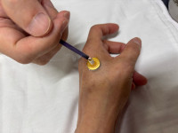 合谷にお灸をしている様子