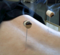 背中に灸頭鍼の施術を行っている。