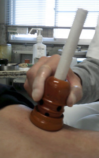 背中に棒灸の施術を行っている。